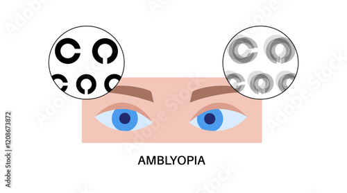 Amblyopia or lazy eye