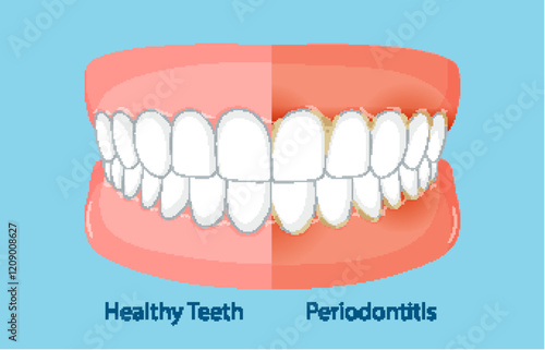 Comparison of Healthy Teeth and Periodontitis