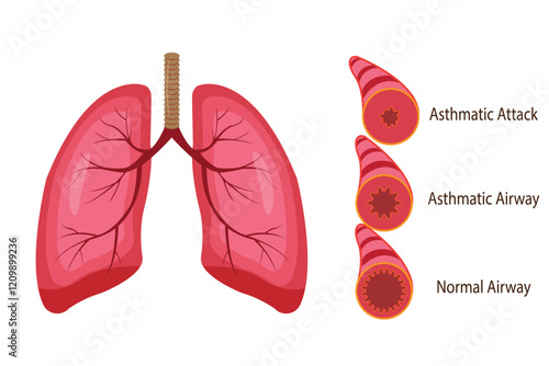 illustration of asthmatic airway,  medical illustration.