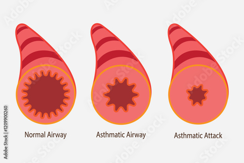 Stages of an asthma attack. medical illustration. eps 10