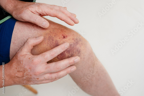 Knie nach Fahrradunfall, Hämatom in schillernden Farben am Kniegelenk, Bluterguss am Männerknie