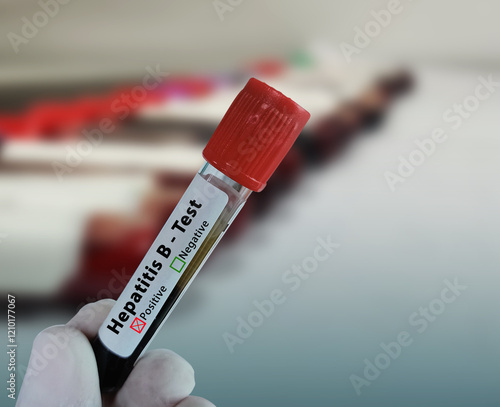 Doctor hold Blood sample for Hepatitis B virus positive test result. HealthCare and medical concept. photo