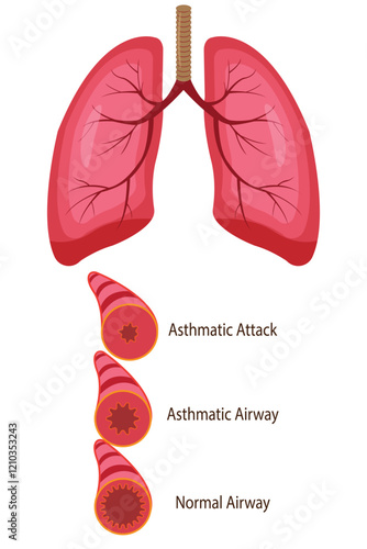 Stages of an asthma attack. medical illustration. eps 10