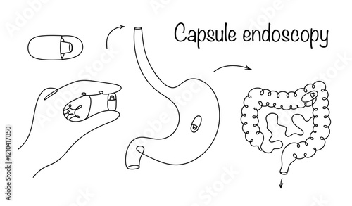 Capsule endoscopy