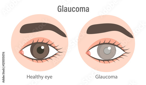 Glaucoma eye. Inflammatory, neovascular, traumatic glaucoma. Medical infographic banner