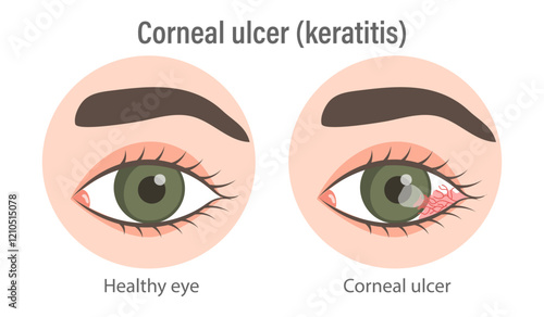 Illustration of corneal ulcer (keratitis). Healthy eye and eye with corneal ulcer. Medical infographic banner