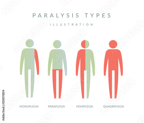 Types of Paralysis - Illustration