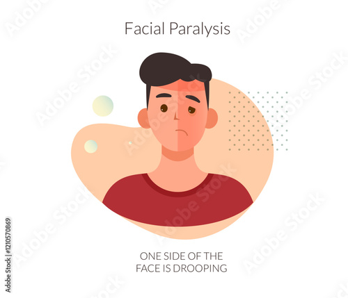 Facial Paralysis  - Bell's palsy - Stock Illustration