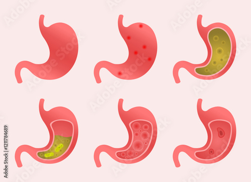 Medical illustration of various human stomach conditions showcasing digestive health issues for educational and clinical use.