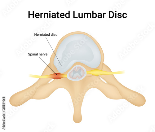 Causes of Herniated Lumbar Disc