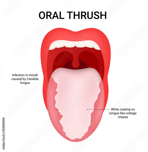 Diagram of Oral Trush Symptoms