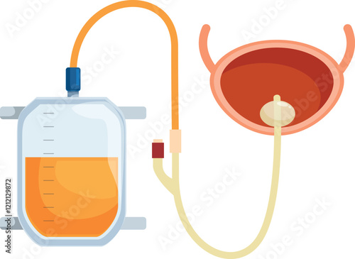 Medical illustration showing urinary catheter draining urine into collection bag, highlighting bladder function and catheterization process