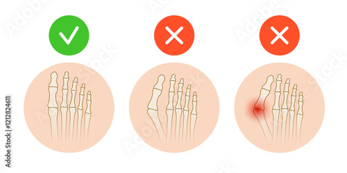 Hallux valgus. Valgus deformity of the big toe joint. Vector illustration.