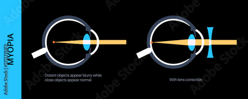 Myopia lens correction