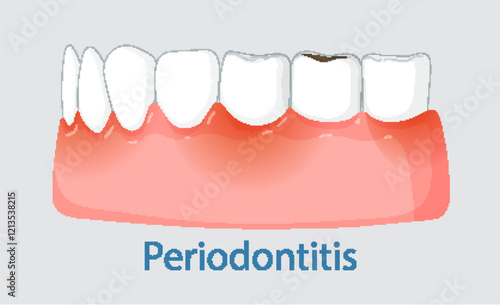 Understanding Periodontitis and Oral Health