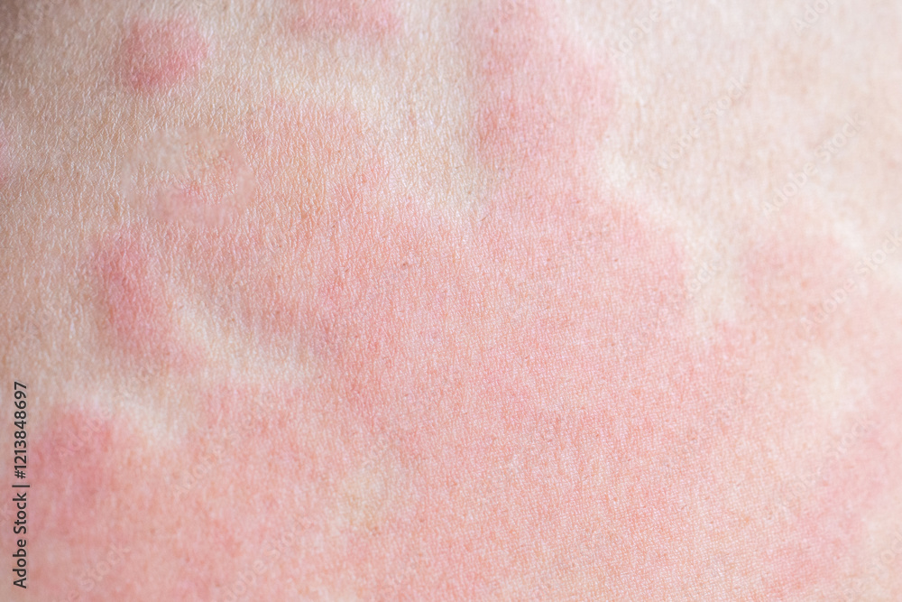 Fototapeta premium Skin allergy rash dermatitis texture close up