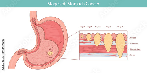 Anatomical medical illustration of stomach cancer hand drawn style