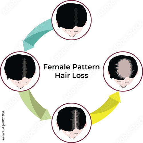 Female Pattern Hair Loss Stages Design Vector Illustration