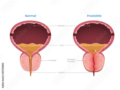 Illustration of Prostatitis Diagram Normal vs Enlarged Prostate