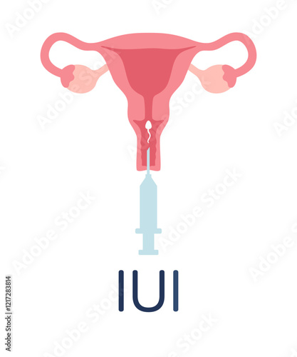 Intrauterine insemination infographic. IUI poster. Uterus and syringe with sperm illustration in cartoon flat style