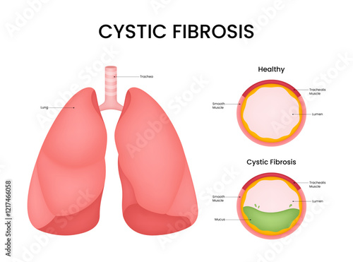 Cystic Fibrosis Symptoms and Causes