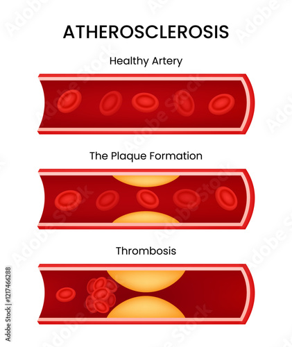 Atherosclerosis Plaque Formation and Thrombosis