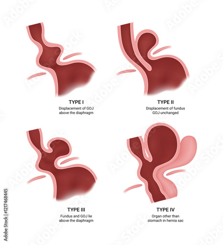 Types of the Hiatal Hernia and Symptoms