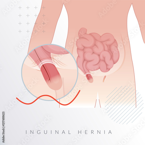 Strangulated Inguinal Hernia-  Section of the Intestines - Stock Illustration