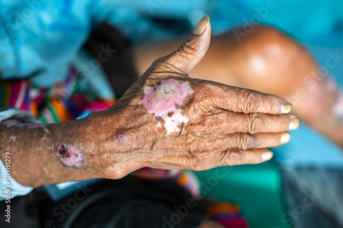 Close up The wound is infected and the skin begins to form on blurred background.Medical and healthcare concept.select focus.