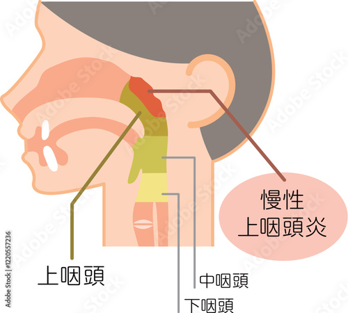 慢性上咽頭炎の説明図・カラー・図解_イラスト