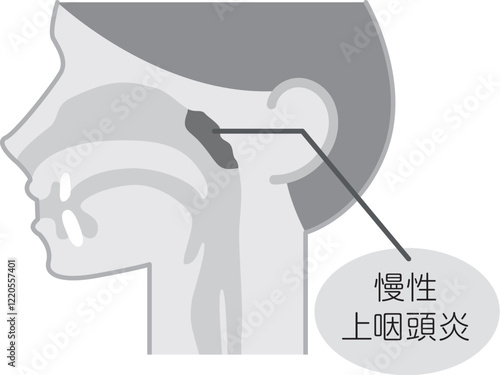 慢性上咽頭炎の説明図・白黒・シンプルな図解_イラスト
