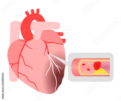 心筋梗塞になった心臓と血栓のイラスト