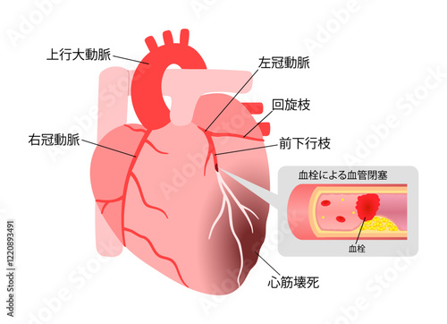 心筋梗塞を起こした心臓の血栓の説明入りイラスト