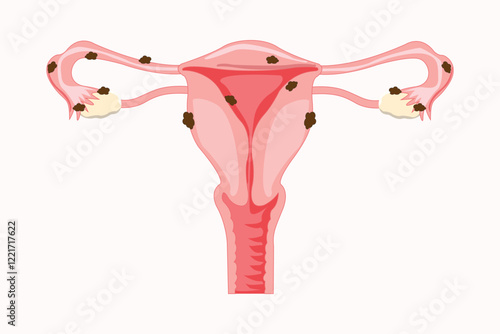 illustration of endometriosis. medical illustration. eps 10