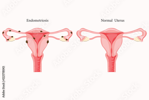 comparison of normal uterus and endometriosis. medical illustration