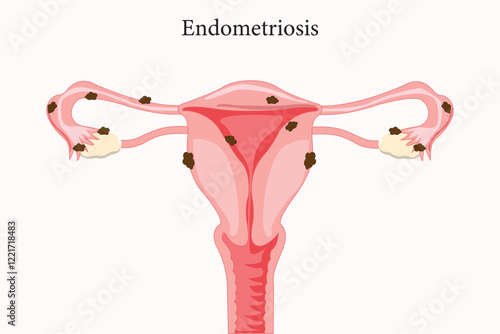 An illustration of endometriosis showing uterine tissue growing outside the uterus. medical illustration. eps 10