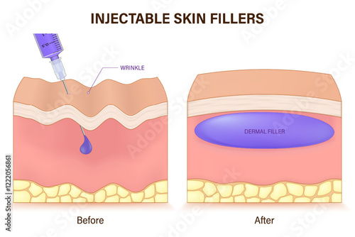 Injectable skin fillers. Dermal fillers. Skin before and after injecting of filler. Vector for advertising about beauty and medical treatment.