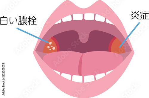 扁桃炎の説明図・説明イラスト素材