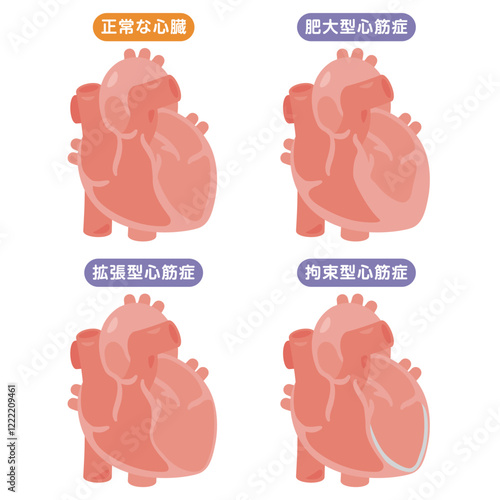 正常な心臓と心筋症の心臓イラストセット