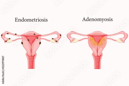 illustration of adenomyosis and endometriosis. medical illustration