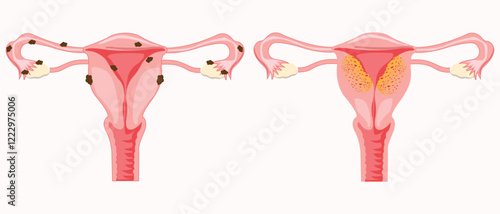 illustration of adenomyosis and endometriosis. eps 10. medical illustration