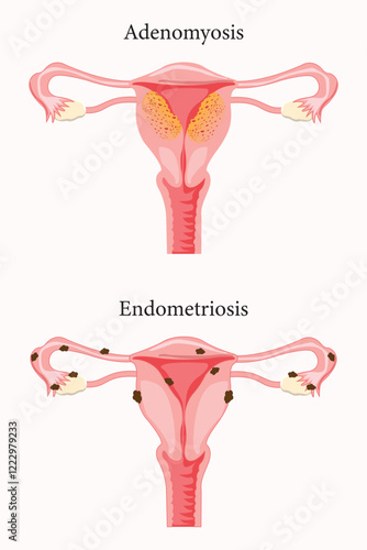 illustration of adenomyosis and endometriosis. eps 10