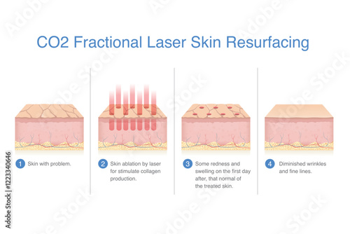 Steps of problem skin treatment with CO2 fractional laser to skin resurfacing. Skin ablation by laser energy for stimulate new collagen and elastin production.
