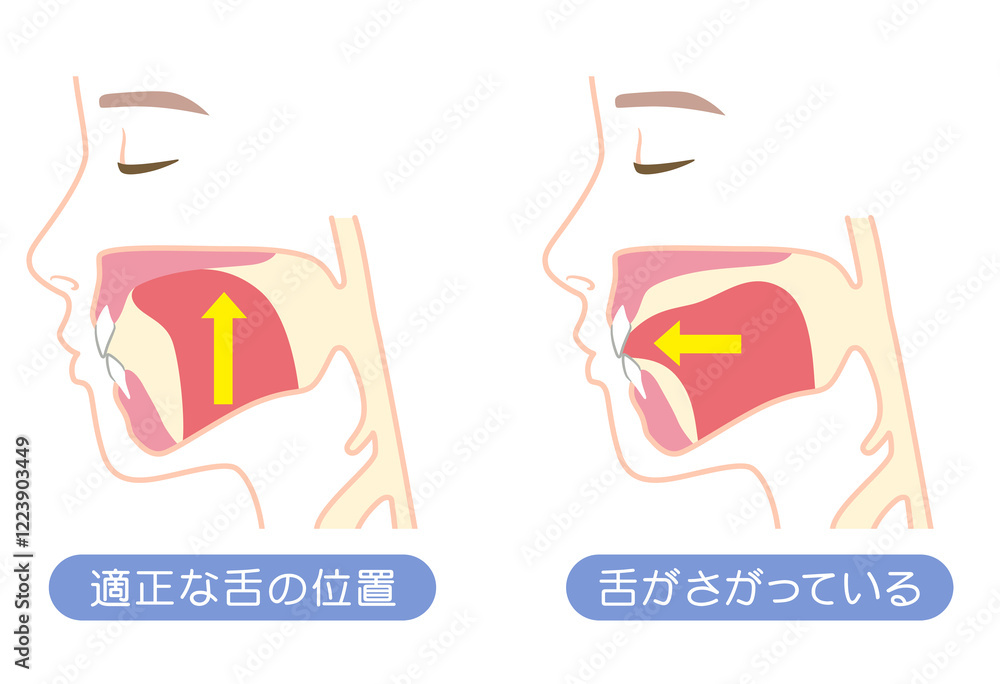 Fototapeta premium 正しい舌の位置と下がっている舌の位置 ミューイング