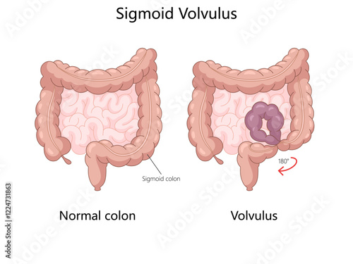 Medical diagram comparing a normal colon with a sigmoid volvulus, twisting of the sigmoid colon causing obstruction hand drawn schematic vector illustration. Medical science educational illustration