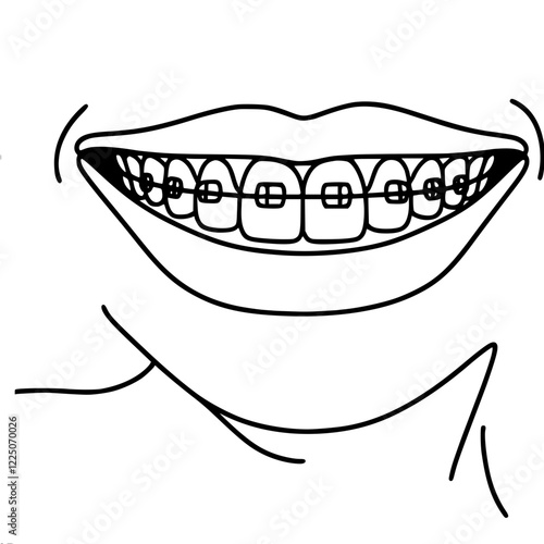 A smile with braces is depicted in a simple black and white vector illustration. Suitable for dental and orthodontic topics. Single line simple outline