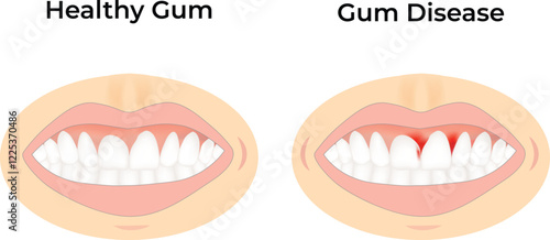 Healthy Gums vs Gum Disease Design Vector Illustration