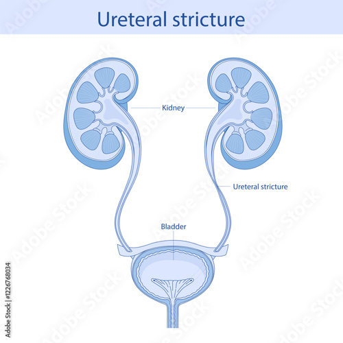 Stricture, stenosis of the ureter, narrowing of the lumen from the kidney to the bladder. Vector medical illustration