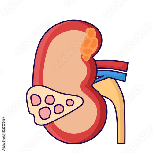 Kidney disease