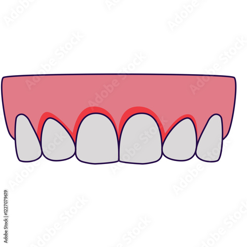 oral gingivitis disease